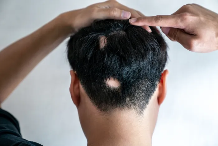 Different patterns of hair loss in Alopecia Areata