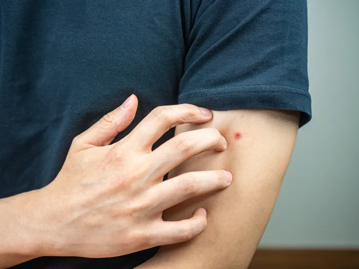 Guy scratching at skin affected by bed bugs