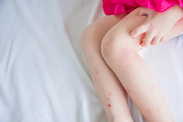 Woman scratching at bed bug bites on her legs