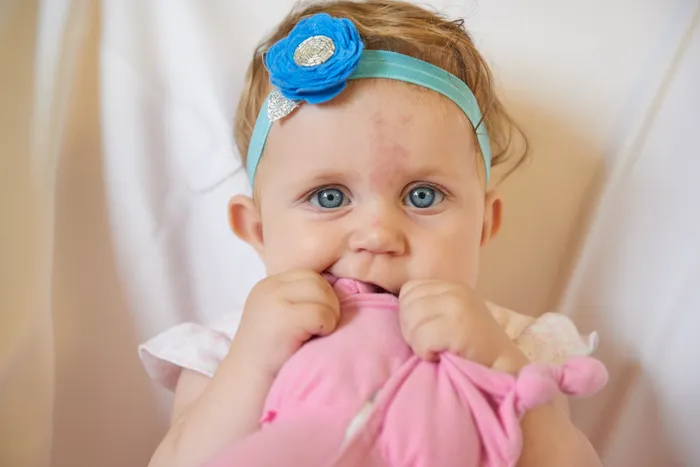 Child with birthmark on face