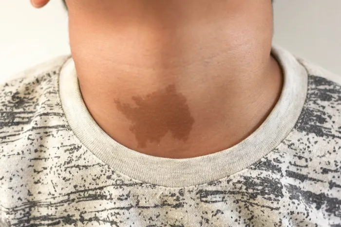 A childd with a birthmark on his neck