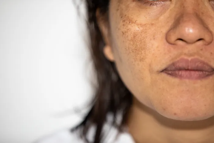 Person with melasma on face