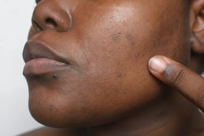 Close-up of skin with brown spots on cheek