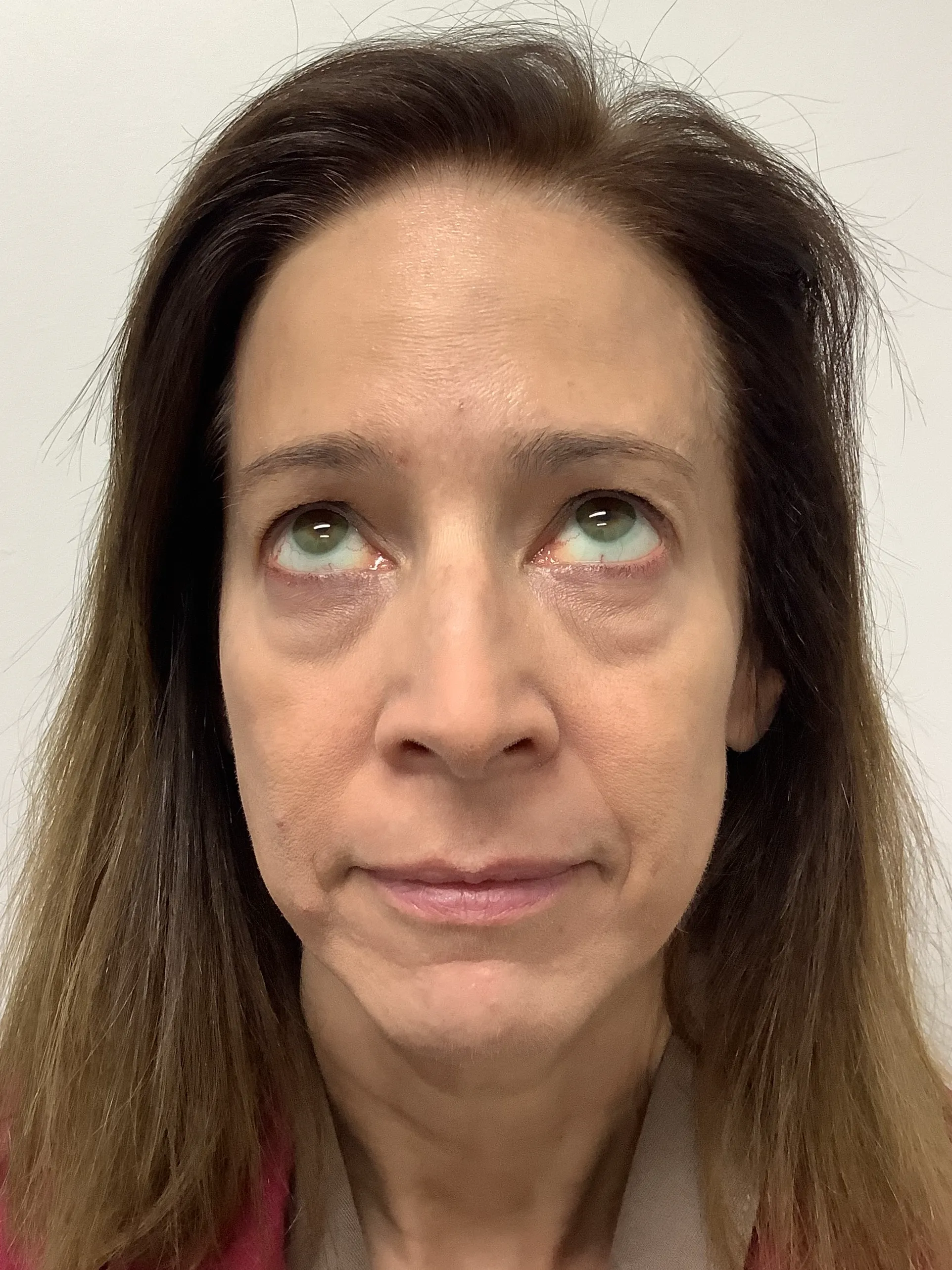 After Botox Treatment Image