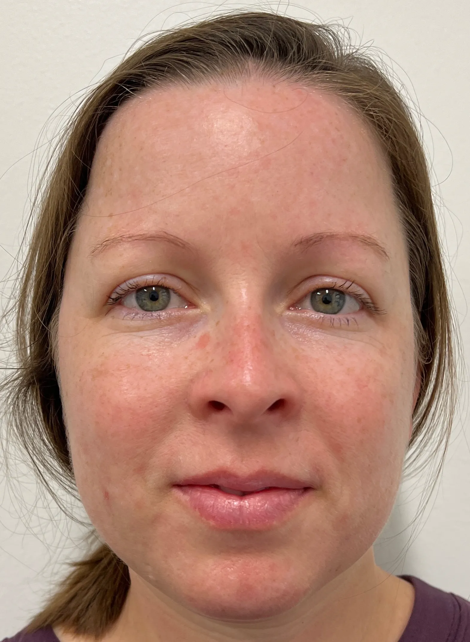 After Rosacea Treatment Image