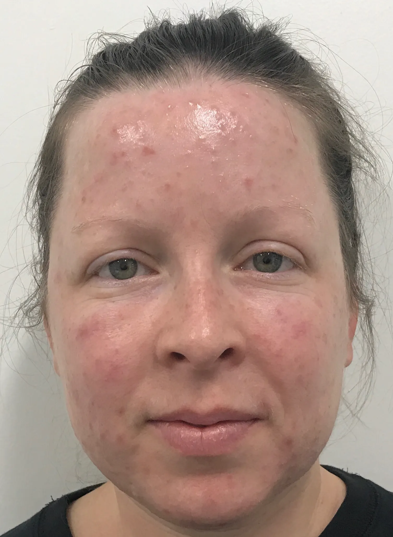 Before Rosacea Treatment Image