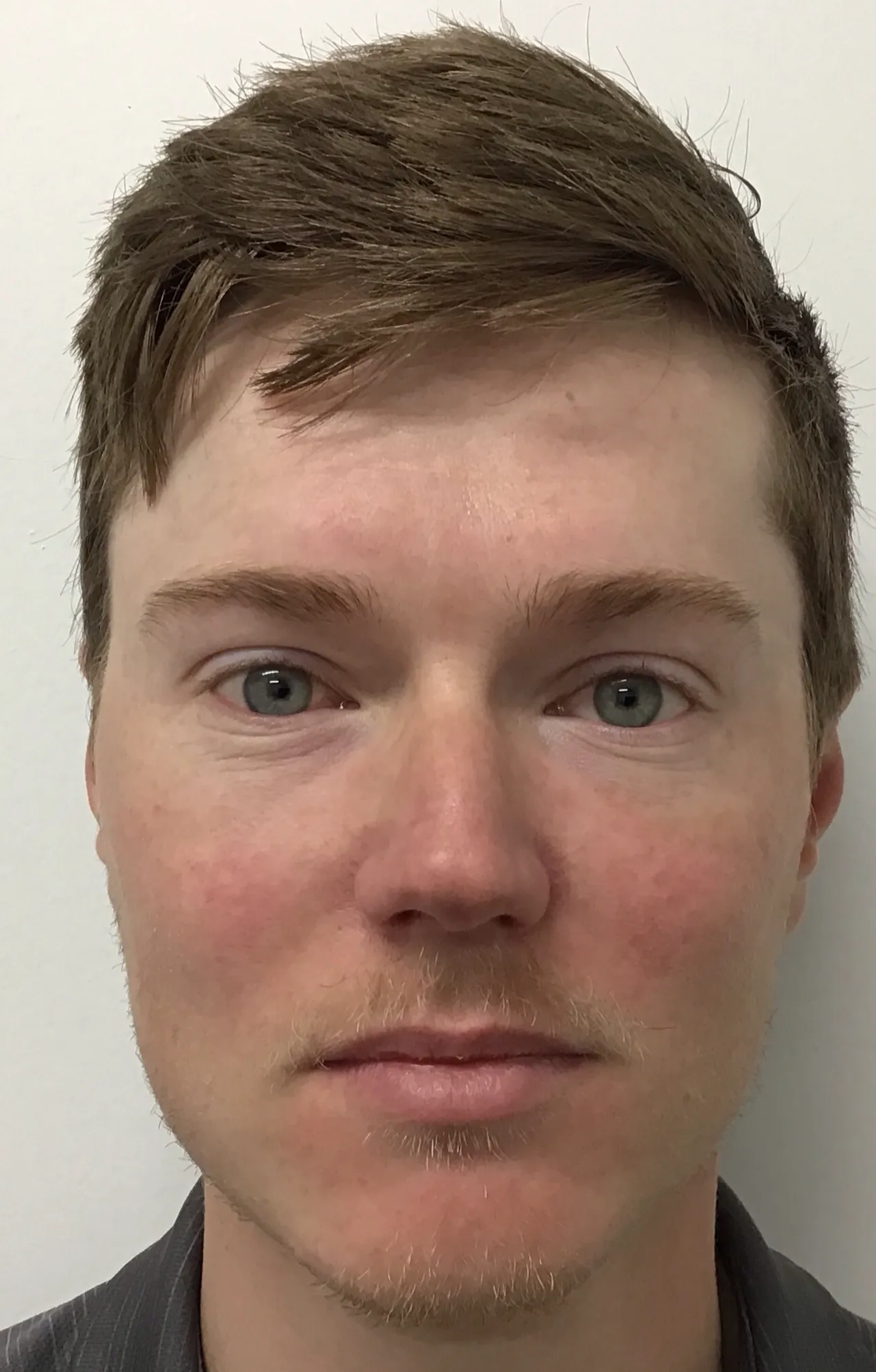 After Rosacea Treatment Image