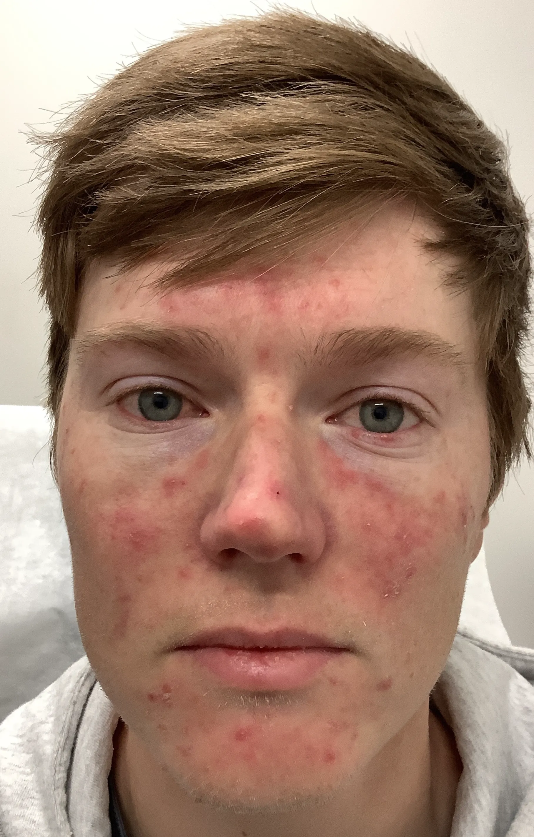 Before Rosacea Treatment Image