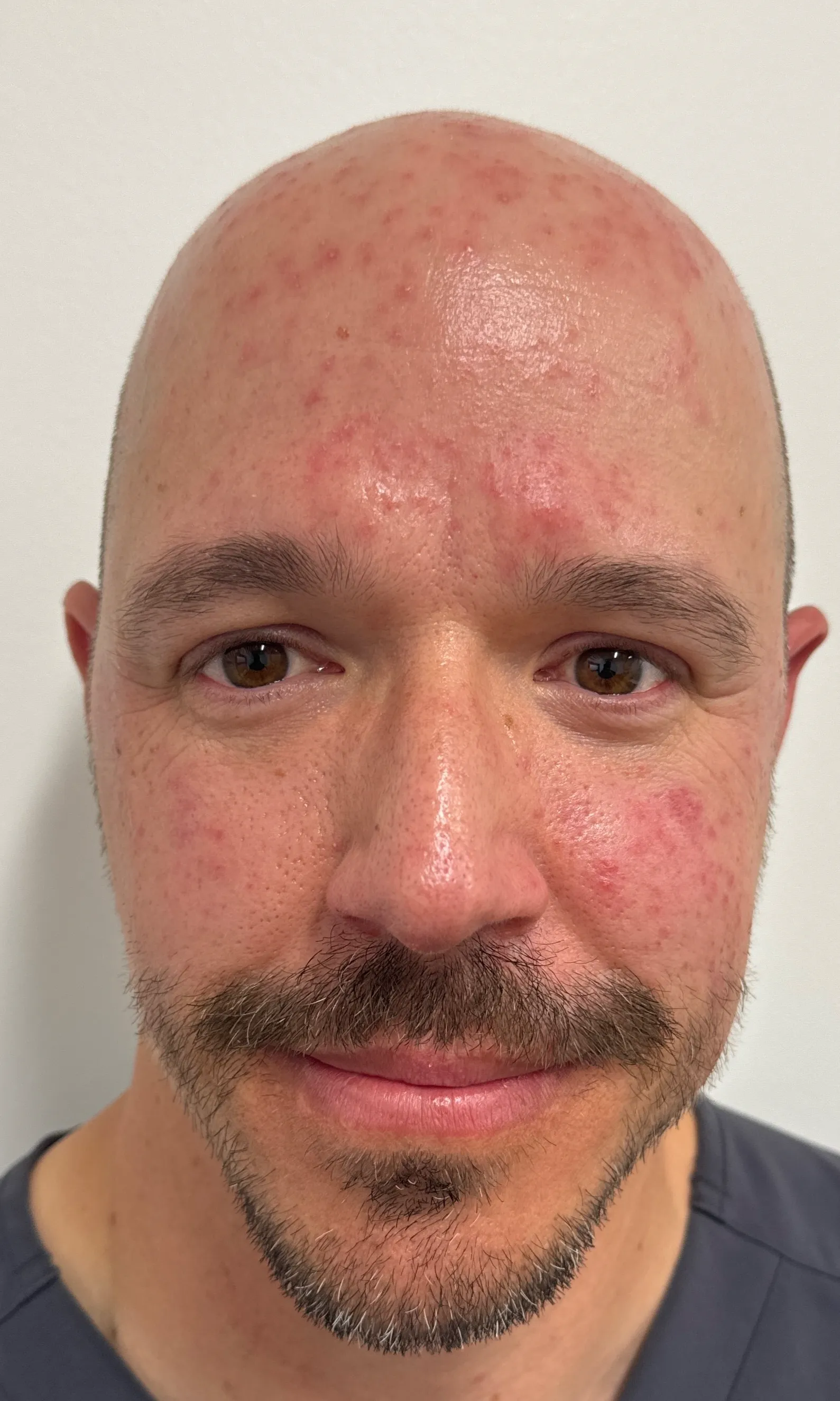 Before Rosacea Treatment Image