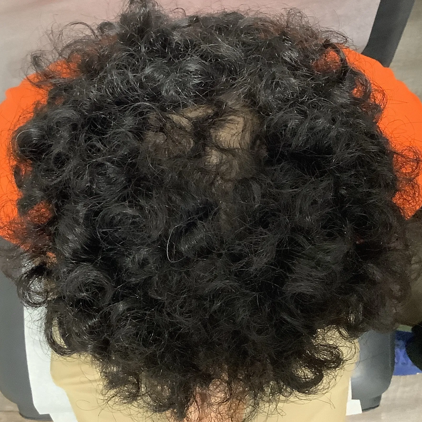 After Alopecia Treatment Image