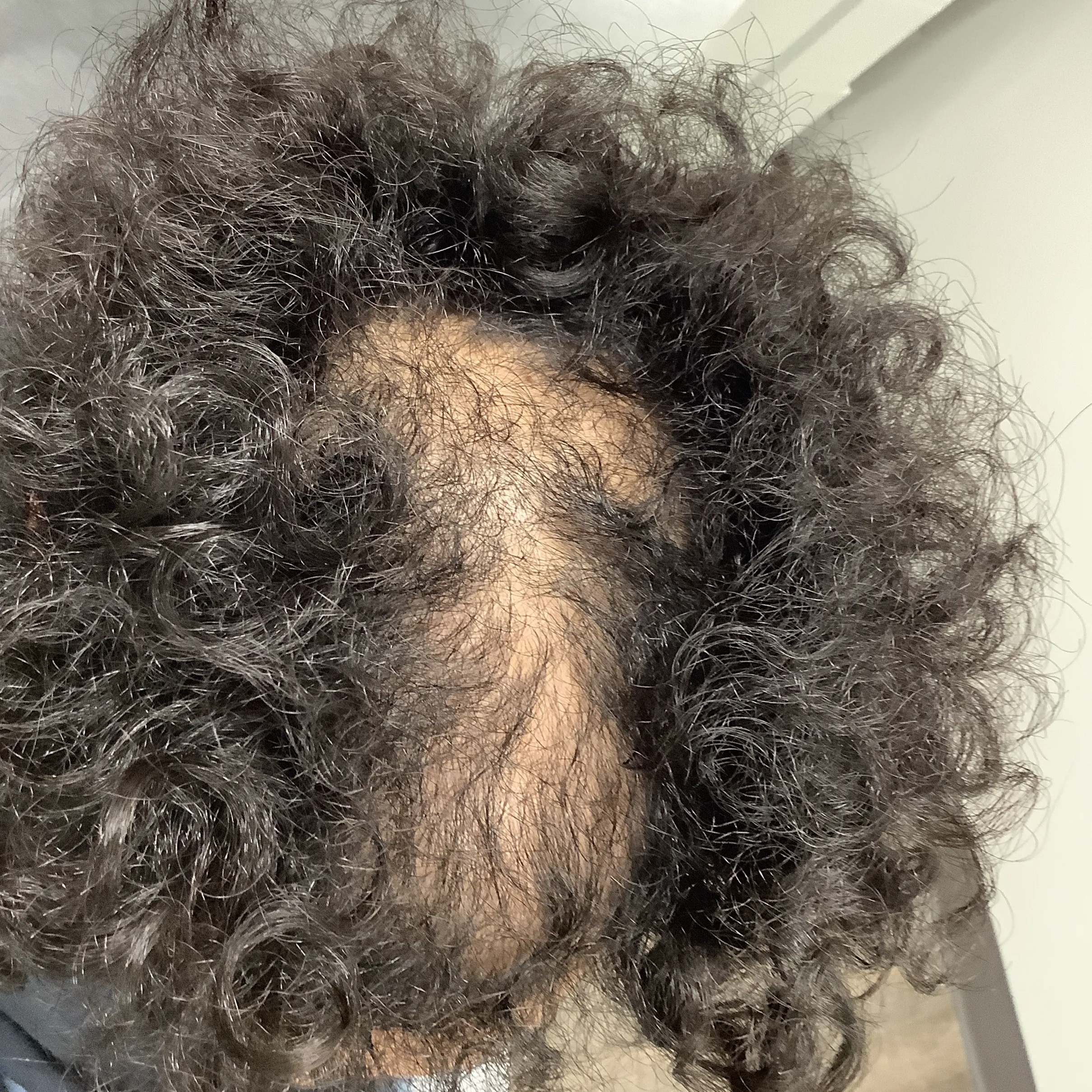 Before Alopecia Treatment Image