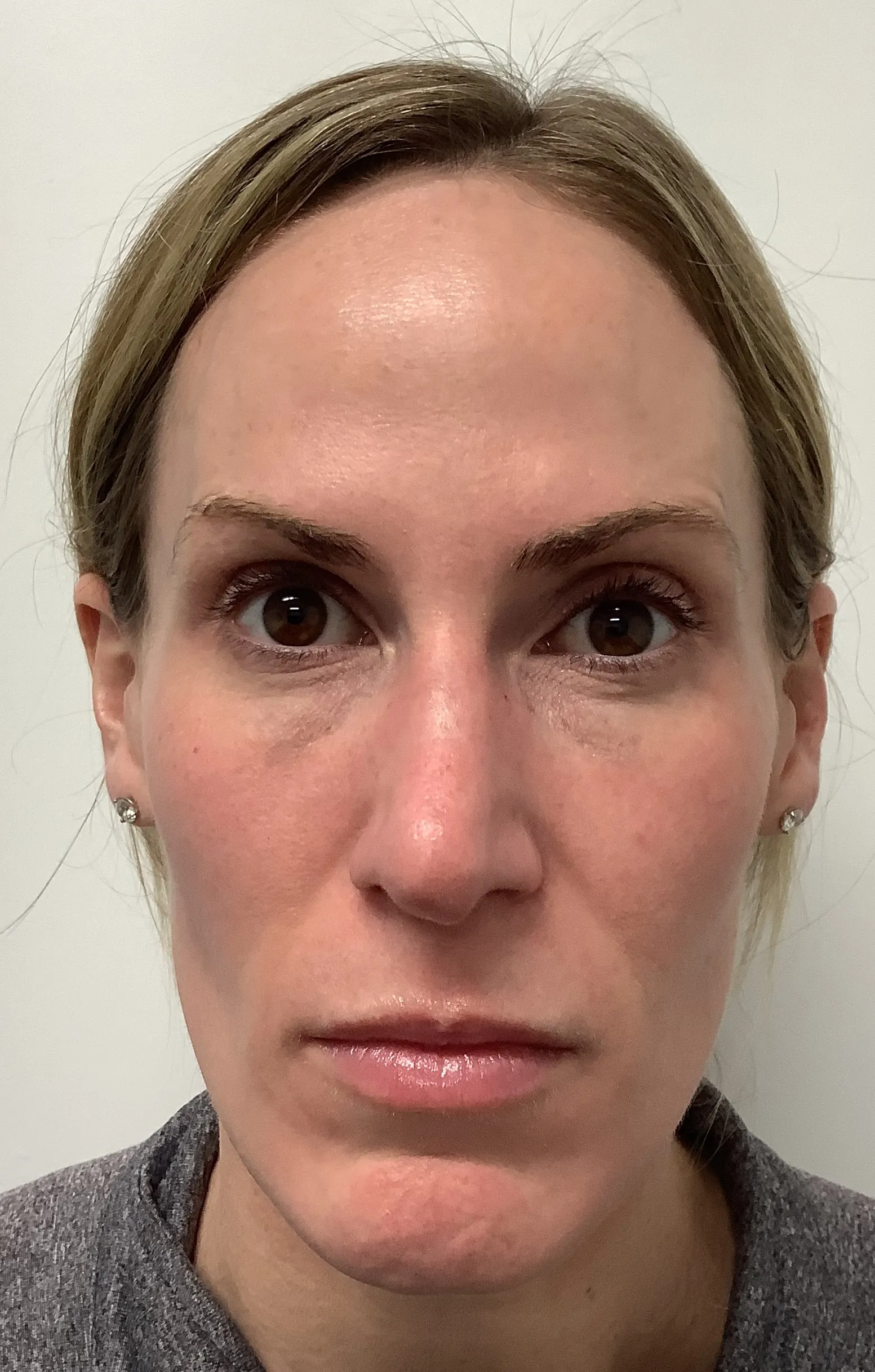 After Botox Treatment Image