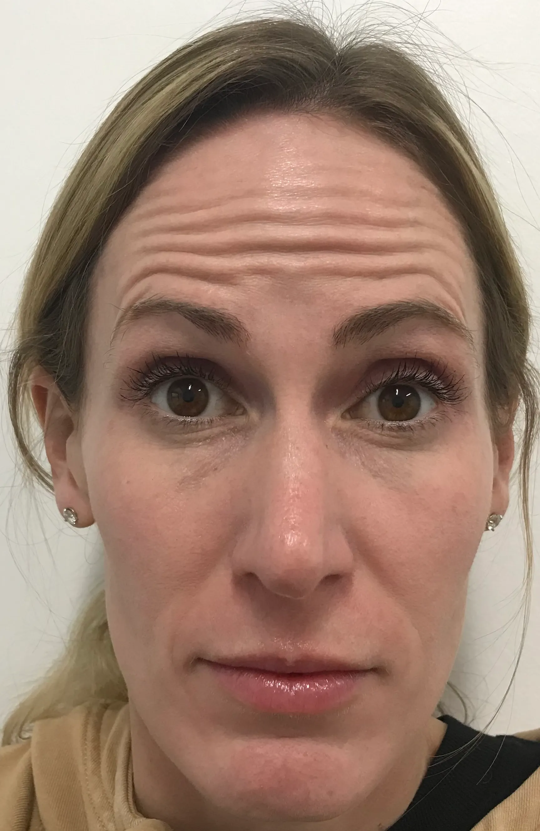 Before Botox Treatment Image