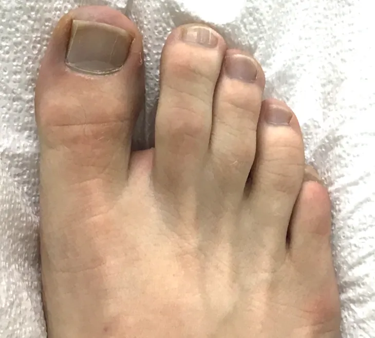 After Onychomycosis Treatment Image