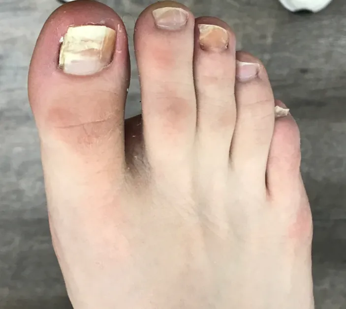 Before Onychomycosis Treatment Image