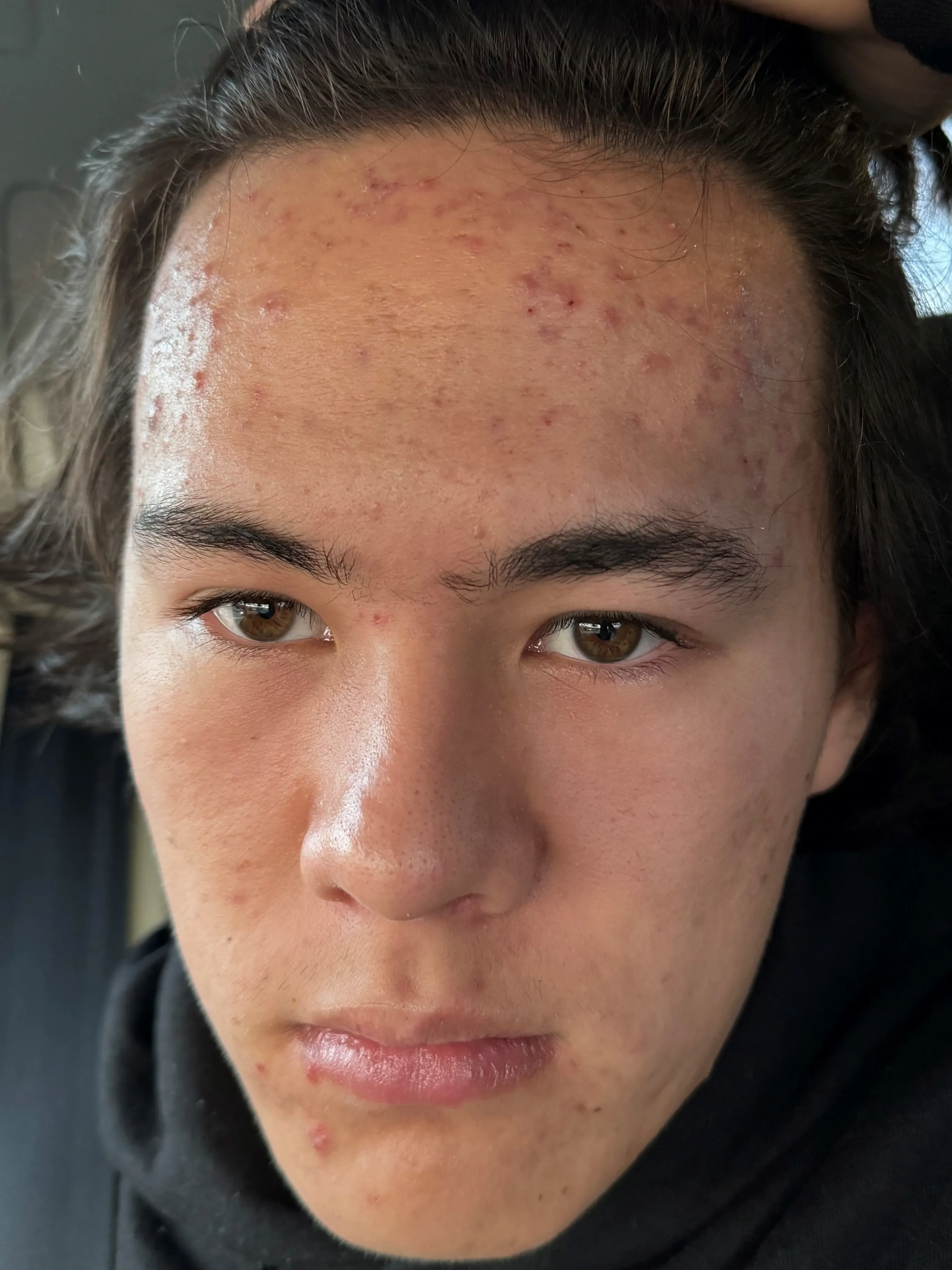 Before Acne Treatment Image