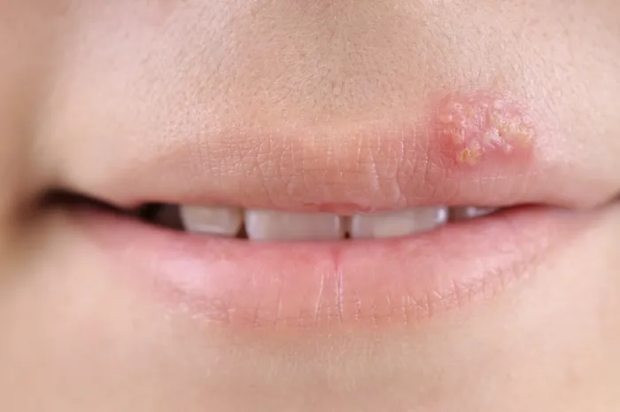 Close up of cold sore on a lip