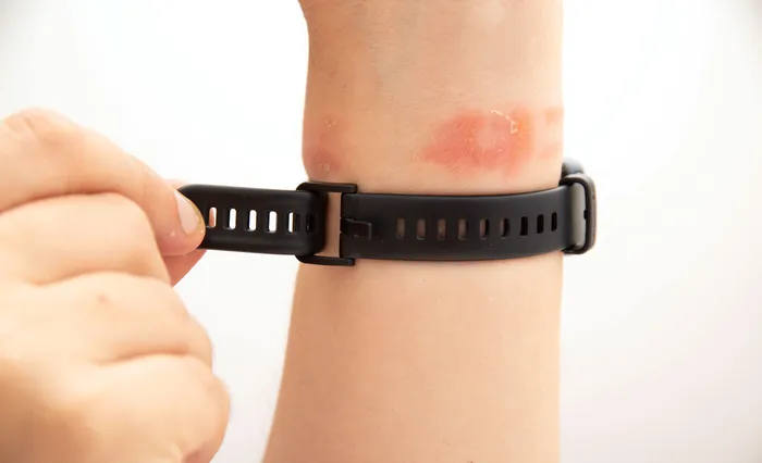 Contact Dermatitis caused by a watch