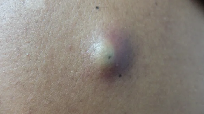 Second Close-up of a person's skin with a visible cyst