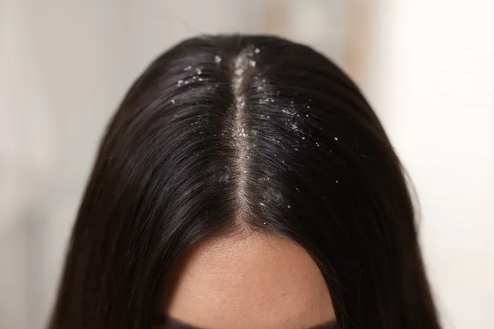 Close-up of a person's scalp with visible dandruff