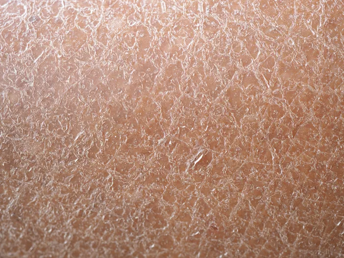 Close-up of dry, flaky skin