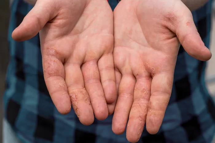 Close-up of hands affected by dyshidrotic eczema