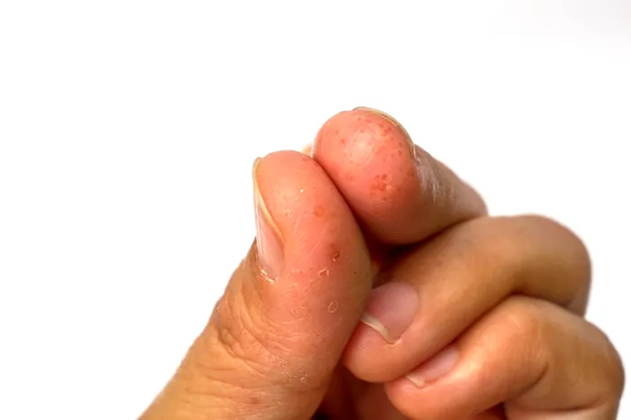 Fingers of a person suffering from Dyshidrotic eczema