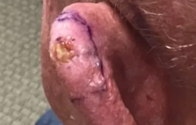 Ear before GentleCure treatment