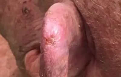 Ear mid-way through GentleCure treatment