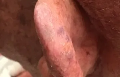 Ear after GentleCure treatment