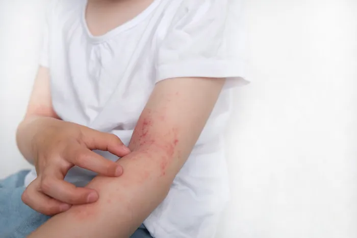 Close-up of arms affected by eczema