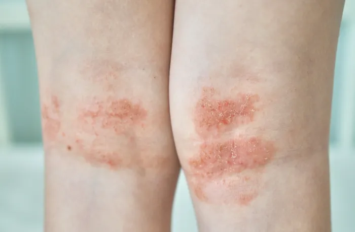 Close-up of inner knees affected by eczema