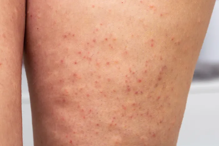 Close-up of skin with folliculitis