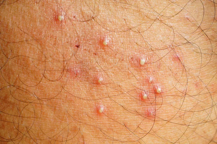 Second close-up of skin with folliculitis