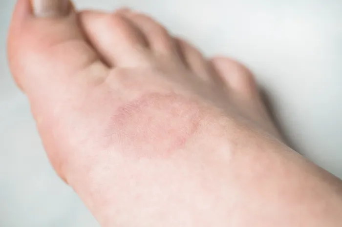 Close-up of skin on foot with granuloma annulare