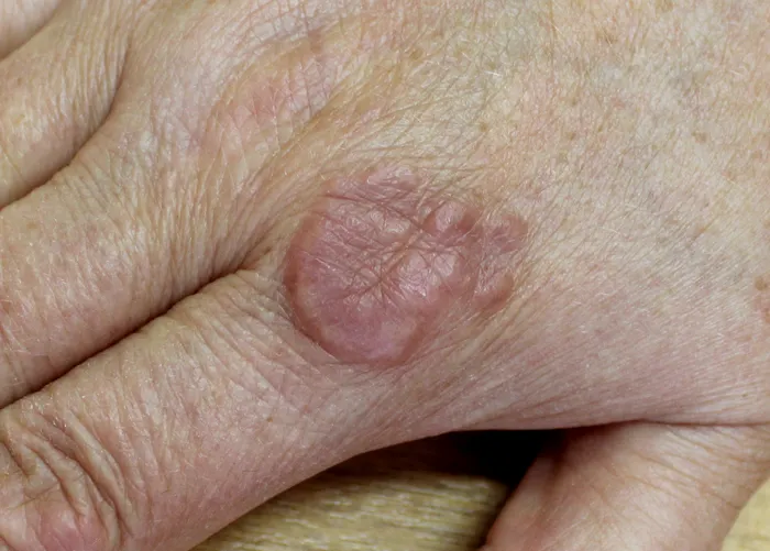 Close-up of skin on hand with granuloma annulare