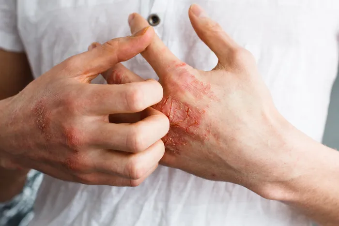 A man scratching his hands, affected by dermatitis