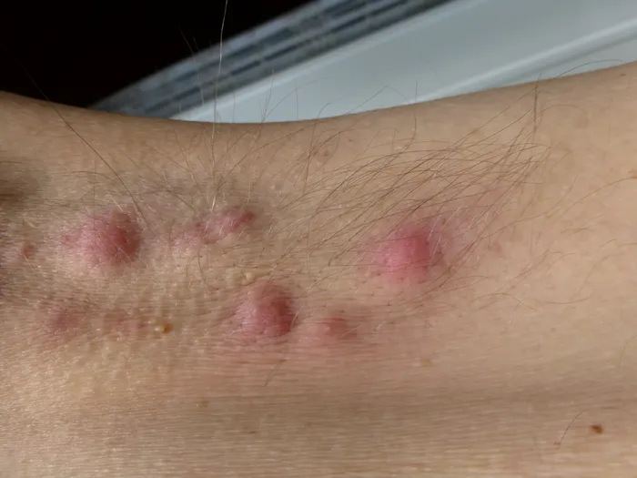 Closer image of underarm skin affected by hidradenitis suppurativa