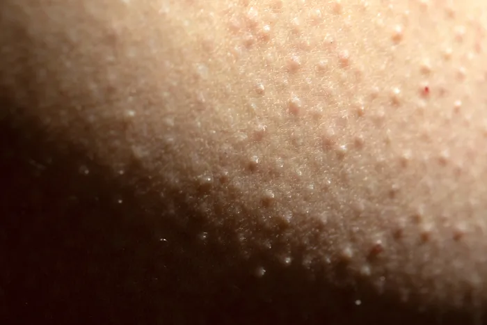 Close-up of skin affected by keratosis pilaris