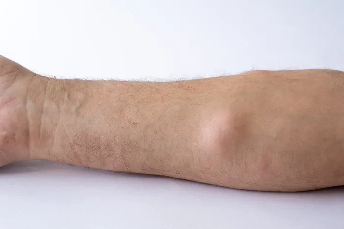 Close-up of a lipoma under the skin of the arm