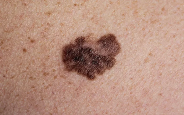 Melanoma on skin