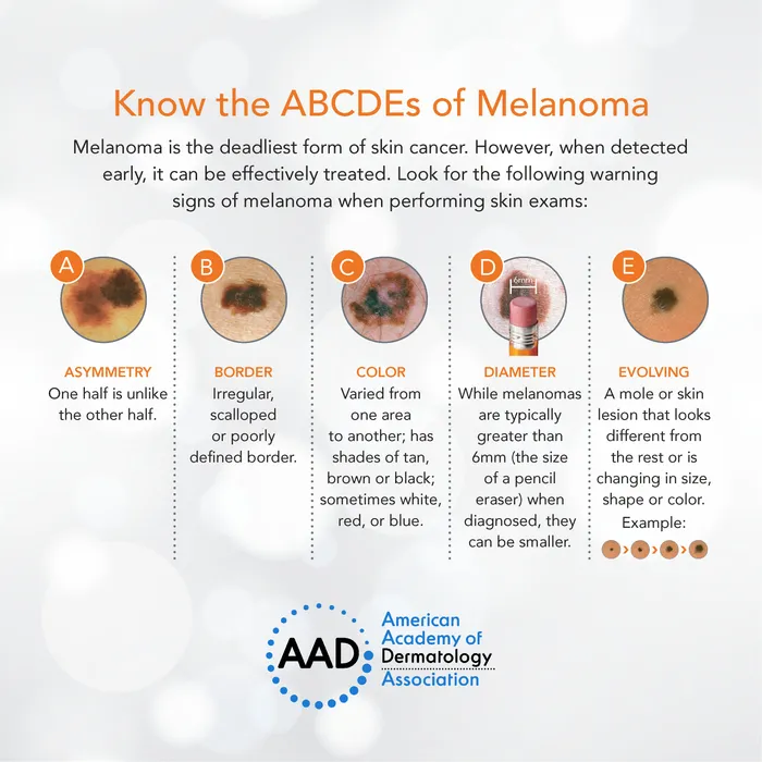 Melanoma on skin