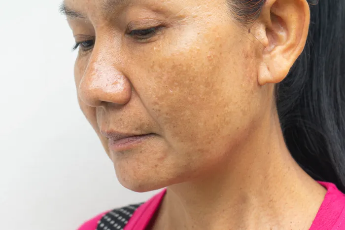 Close-up of melasma patches on a woman's skin