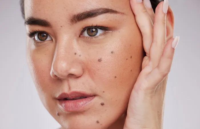 Close-up of a person's face with various moles