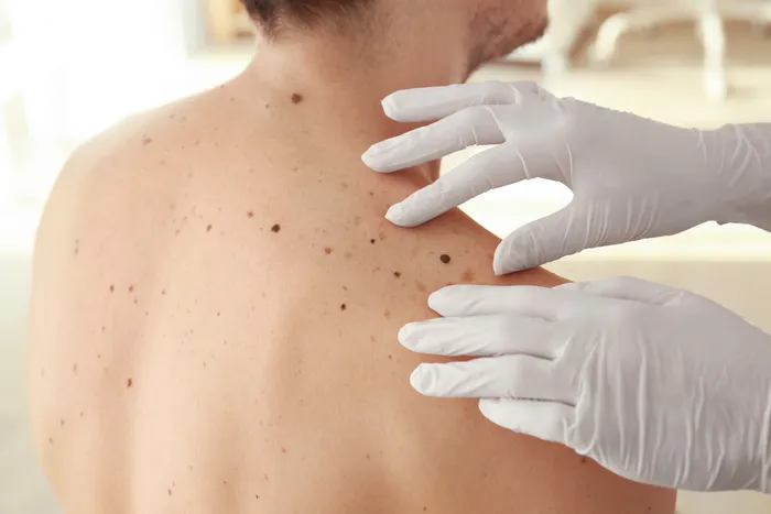 Moles being evaluated on man's back