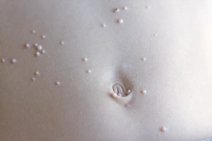 Close-up of molluscum contagiosum on a stomach