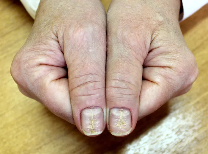 Close-up of various nail disorders