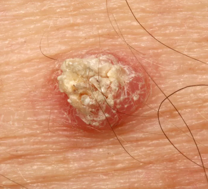 Close Up Image of non-melanoma skin cancer