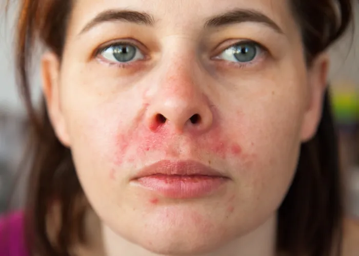 Close-up of perioral dermatitis around the nose and upper lip