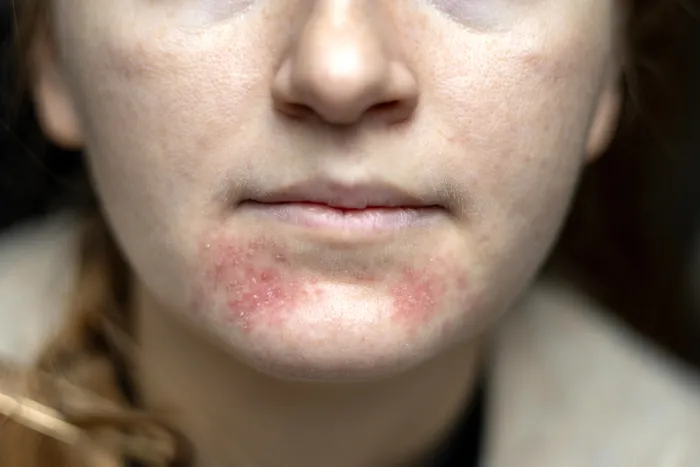 Close-up of perioral dermatitis around the mouth